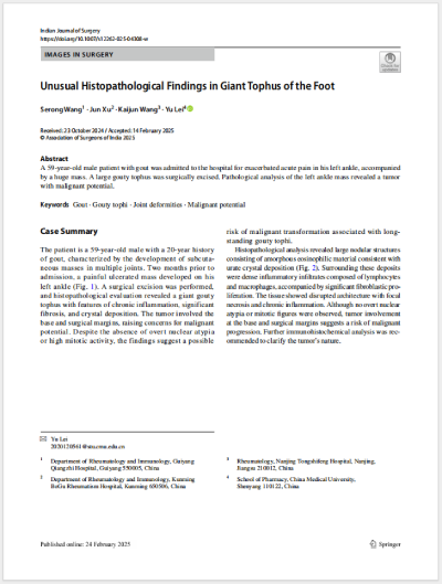 2025.2ɫεȹͬ׫¡Unusual Histopathological Findings in Giant Tophus of the Foot㲿޴ʹL(fng)ʯĮMW(xu)F(xin)SCIڿIndian Journal of Surgeryl(f).png